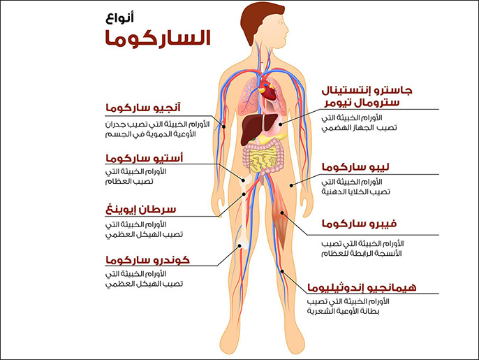 ساركوما العظام ، أنواع الساركوما (صفحة مؤسسة حمد الطبية على فيسبوك)