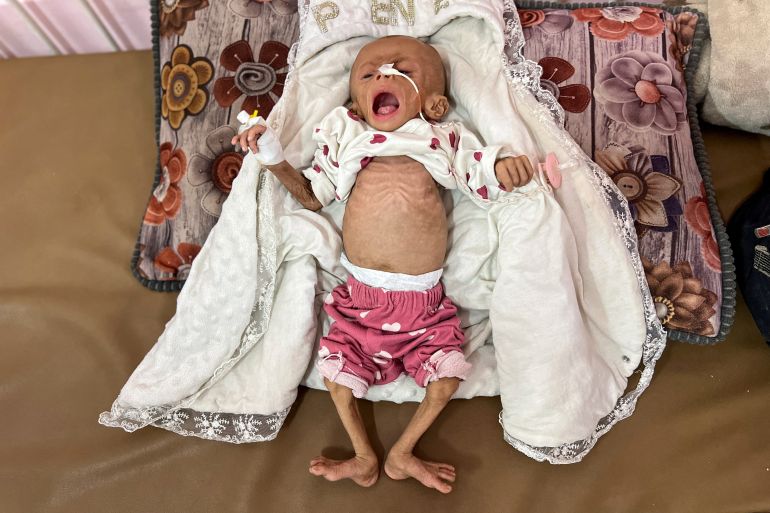 Zainab Abu Haleeb, a five-month-old Palestinian girl diagnosed with malnutrition, according to medics, lies on a bed as she receives treatment at Nasser hospital in Khan Younis, in the southern Gaza Strip July 15, 2025. REUTERS/Hussam Al-Masri TPX IMAGES OF THE DAY