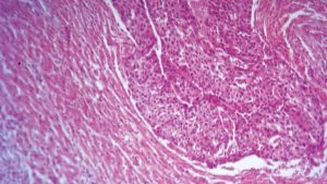 تقنية جديدة لعلاج سرطان الرئة