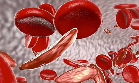 فهد الطبية توضّح أعراض فقر الدم الناتج عن نقص الحديد وعلاجه