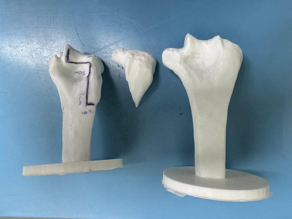 إنجاز طبي نادر.. مستشفى الملك فهد الجامعي ينجح بزراعة مفصل المرفق وترميم الأربطة لشاب عشريني