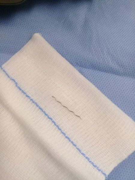 فريق طبي يستخرج "إبرة" من مريء سيدة في القريات