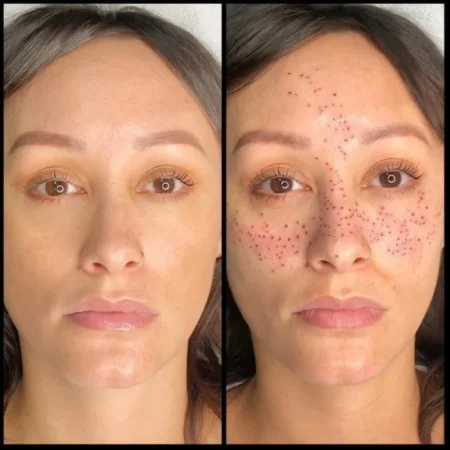 تاتو الكلف.. هل هو جمال طبيعي أم مخاطرة غير ضرورية – أخبار السعودية