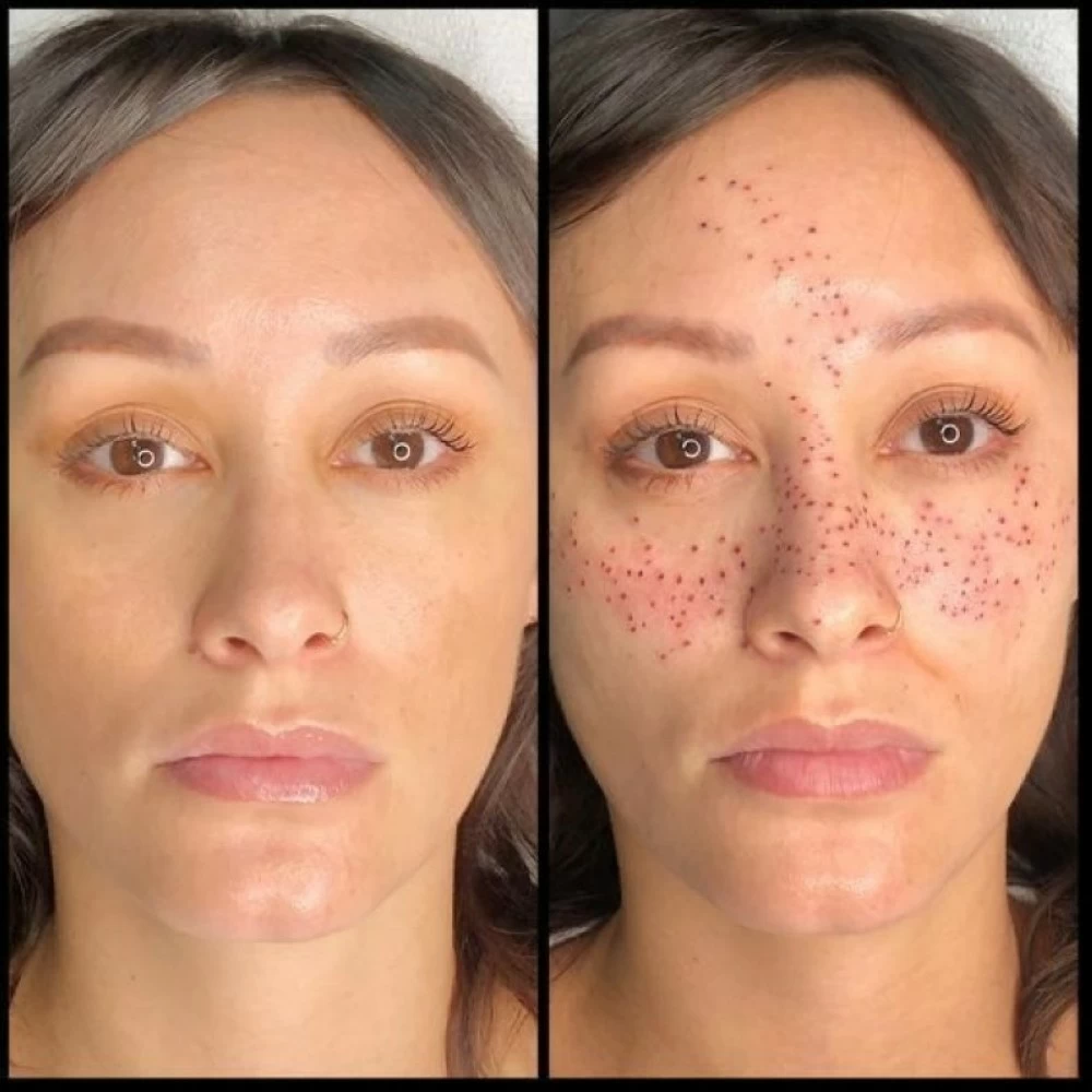 تاتو الكلف.. هل هو جمال طبيعي أم مخاطرة غير ضرورية – أخبار السعودية