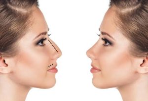 تجميل الأنف في عيادة ميام للتجميل: ملامح أكثر تناسقاً بثقة واهتمام طبي