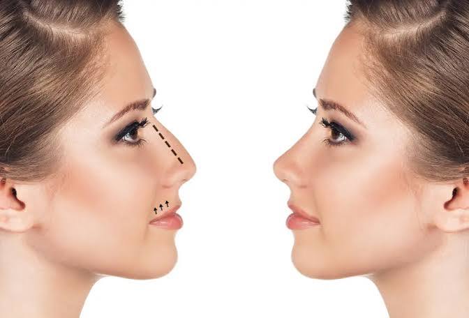 تجميل الأنف في عيادة ميام للتجميل: ملامح أكثر تناسقاً بثقة واهتمام طبي