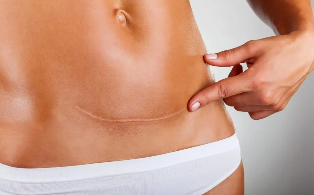 عملية شد البطن في عيادة ميام للتجميل: قوام أكثر تناسقاً وثقة