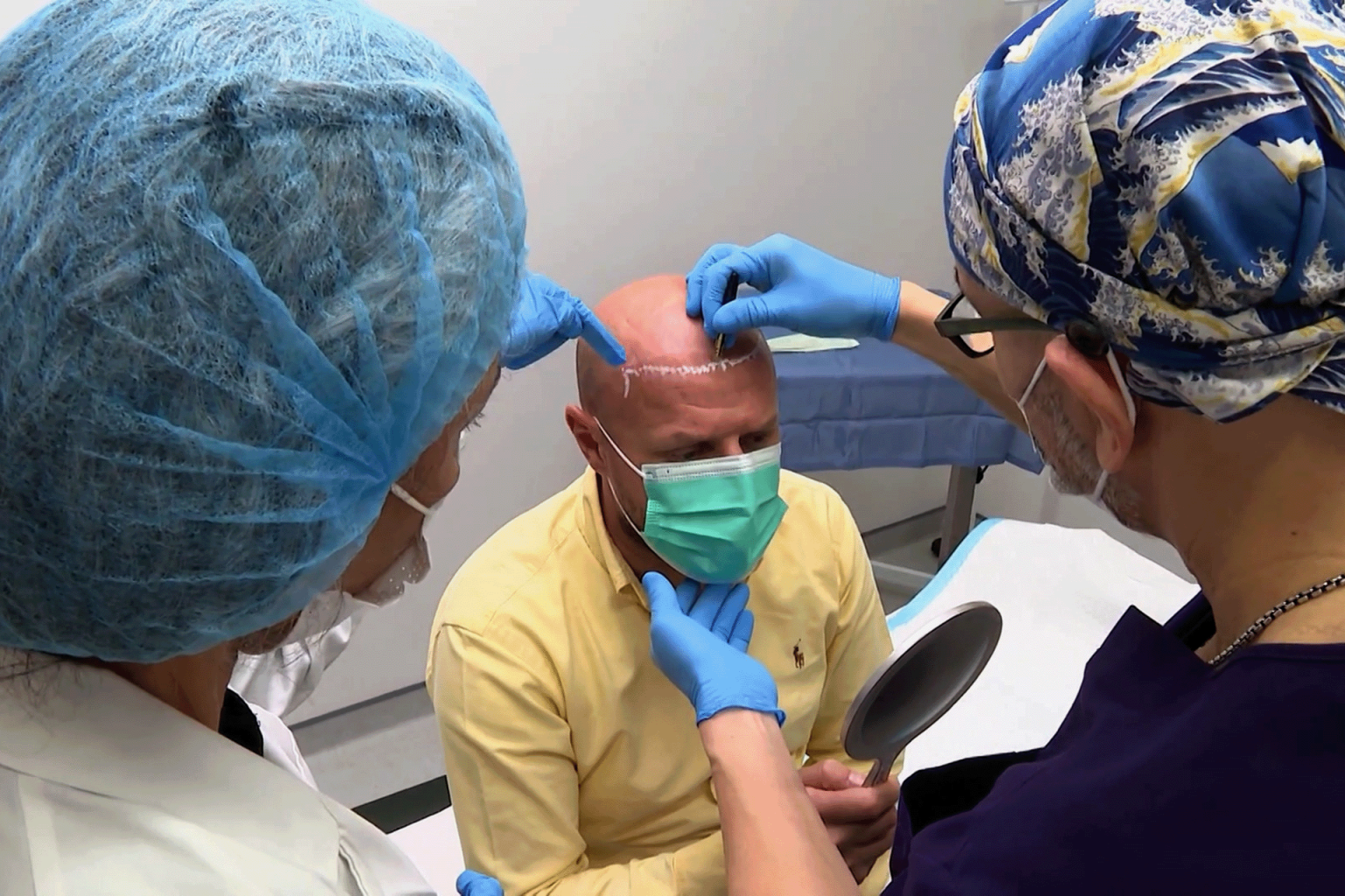 زراعة الشعر ببيوفايبر نتائج فورية بتقنية حديثة