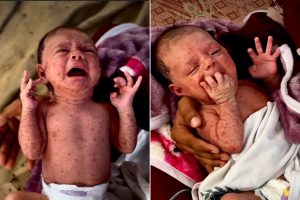تفشي جدري الماء في مخيمات غزة يهدد حياة الأطفال
