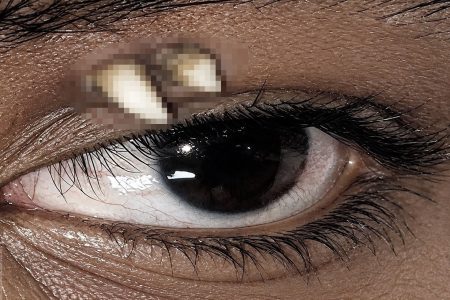 سن نادرة تبرز من جفن مراهق تفاجئ الأطباء