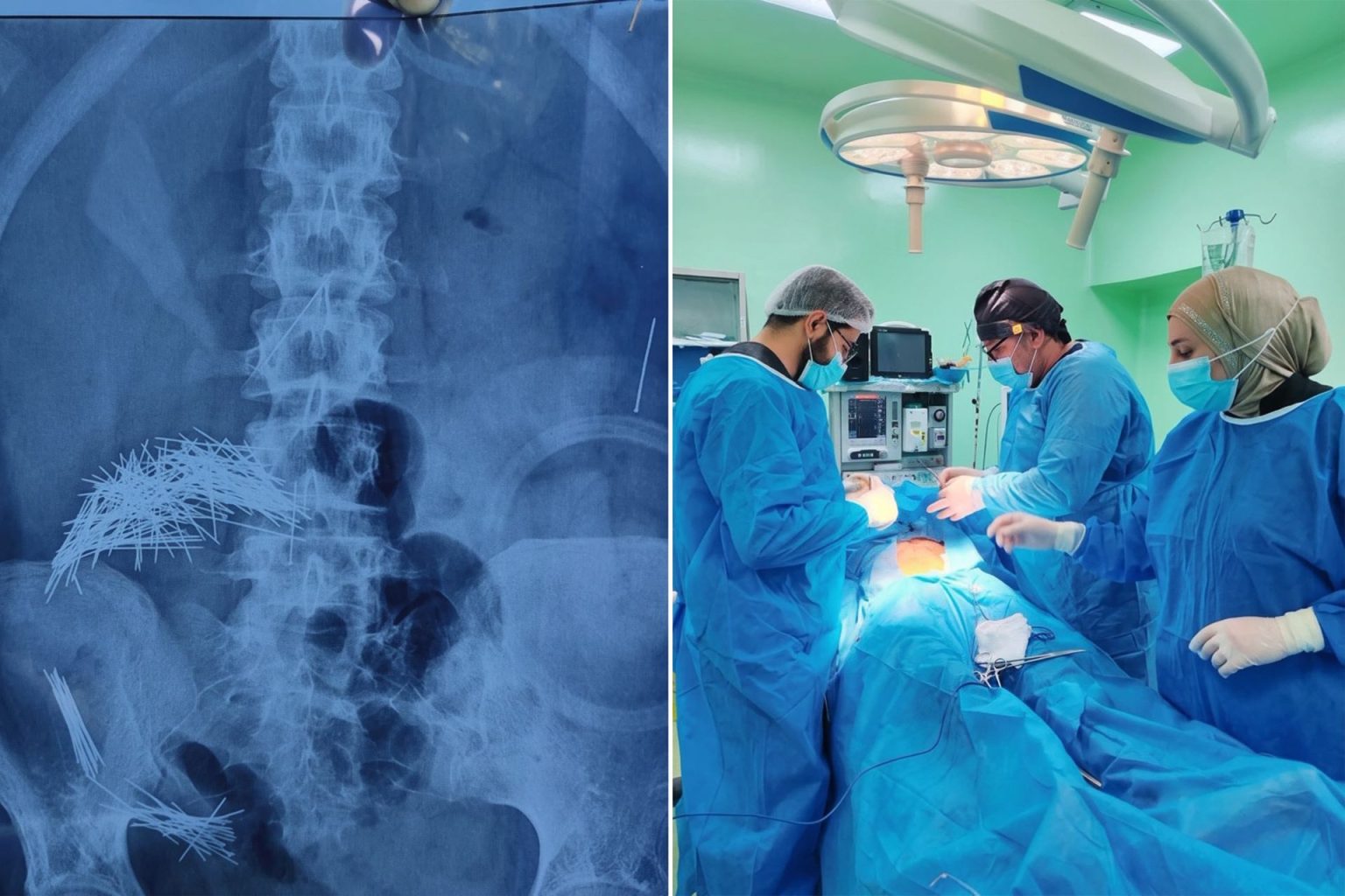 جراحة إنقاذ مذهلة لعراقي لاستخراج 214 إبرة ودبوس من بطنه
