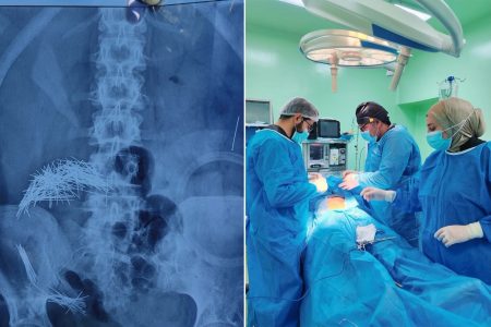 جراحة إنقاذ مذهلة لعراقي لاستخراج 214 إبرة ودبوس من بطنه